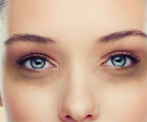 رفع تیرگی دور چشم در سه روز | سیاهی دور چشم نشانه چه بیماری است
