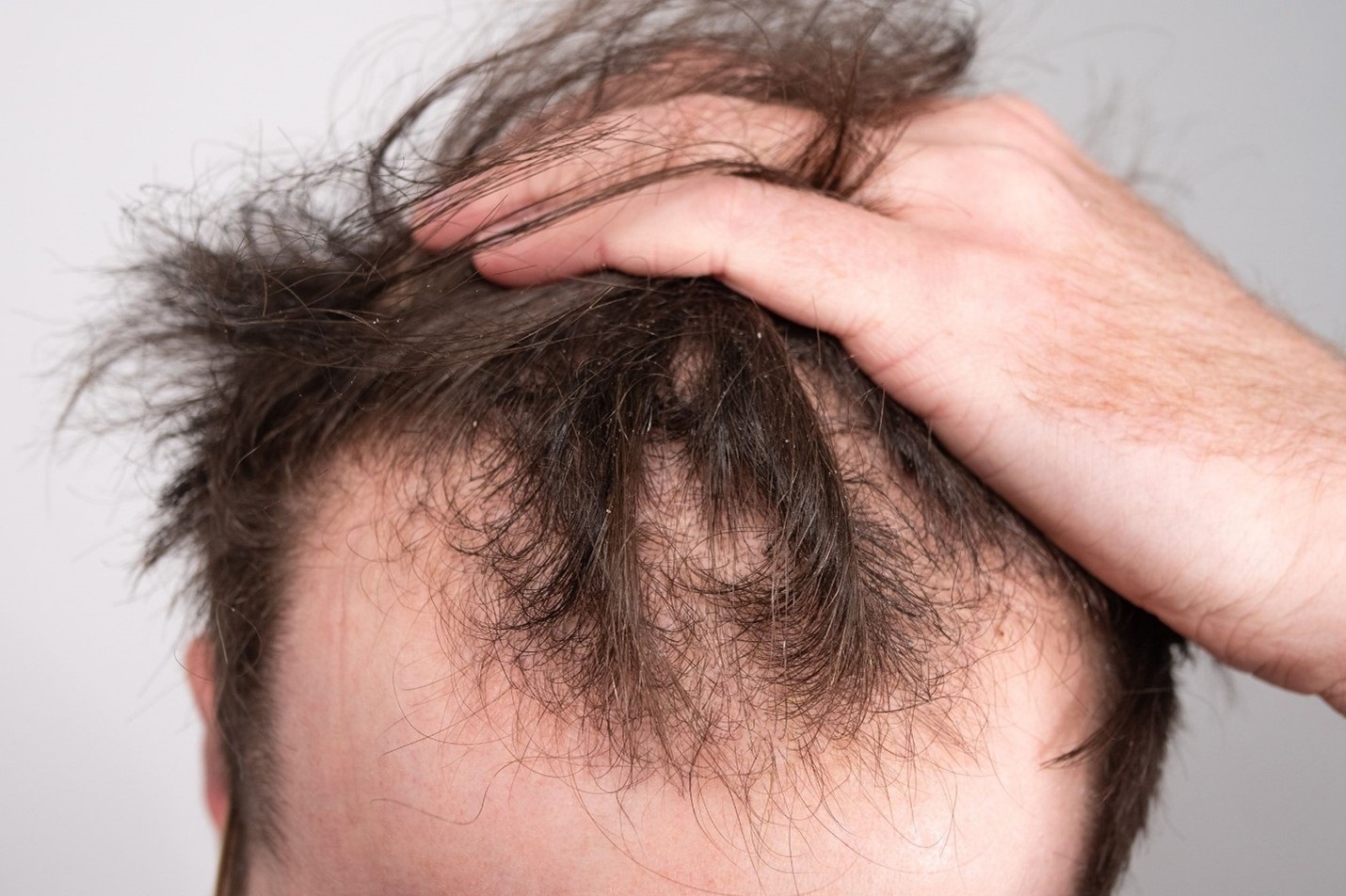 Fast hair loss treatment after corona