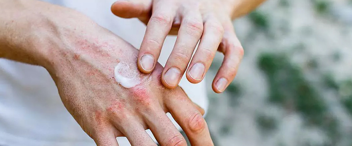 علائم و نشانه‌های اگزما