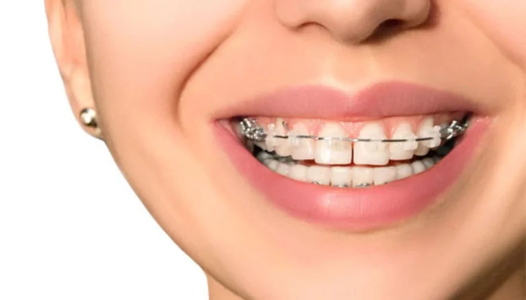آیا ارتودنسی باعث تحلیل ریشه دندان میشود؟