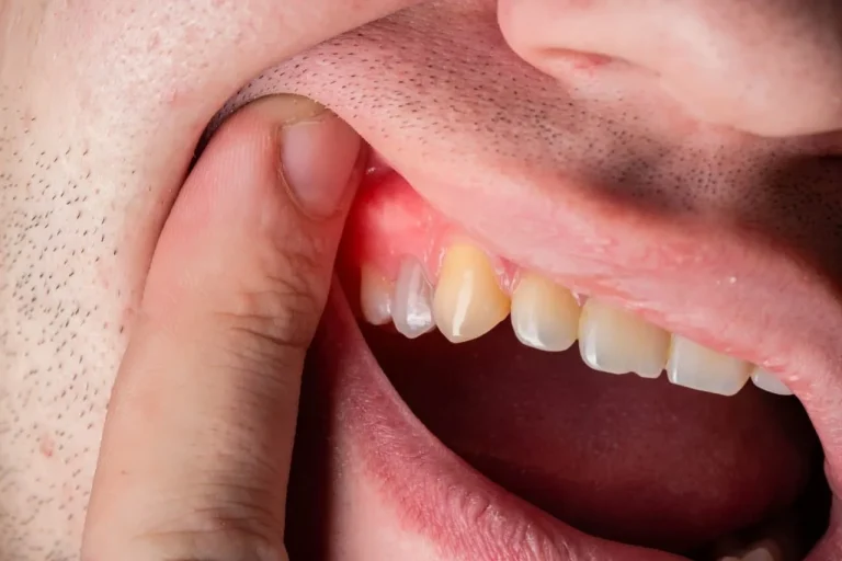 دلیل آبسه لثه چیست