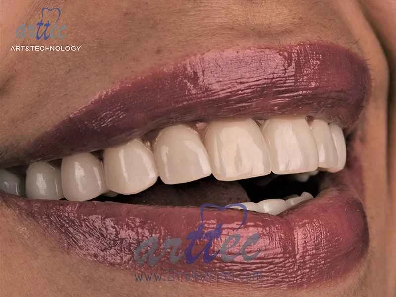 What does dental laminate do