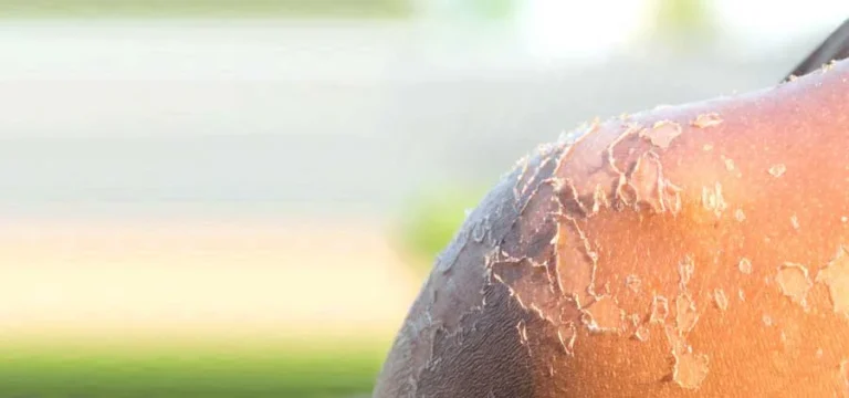 مراقبت از پوست بعد از آفتاب سوختگی : راهی برای پوستی سالم